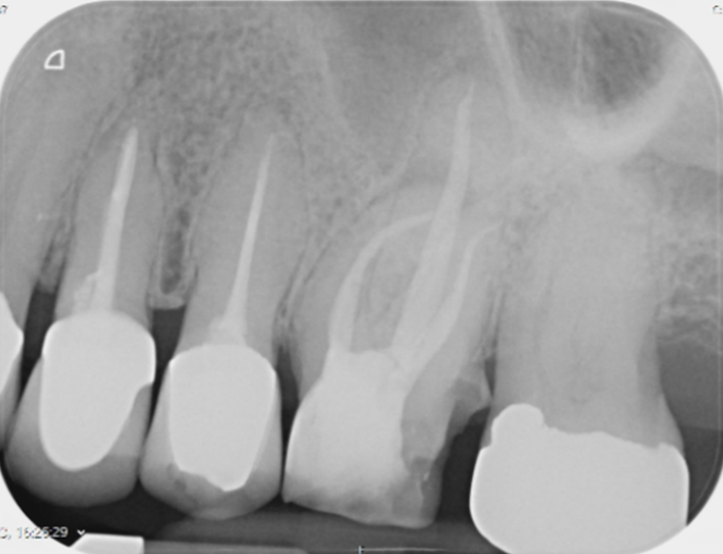 Molar endodontics - Post-op case 4